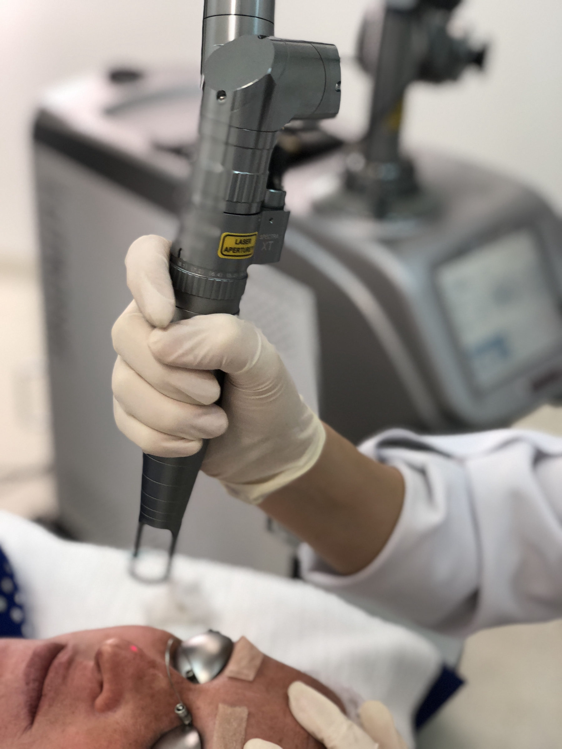 Tratamento de acne com laser Spectra XT na Inpelle