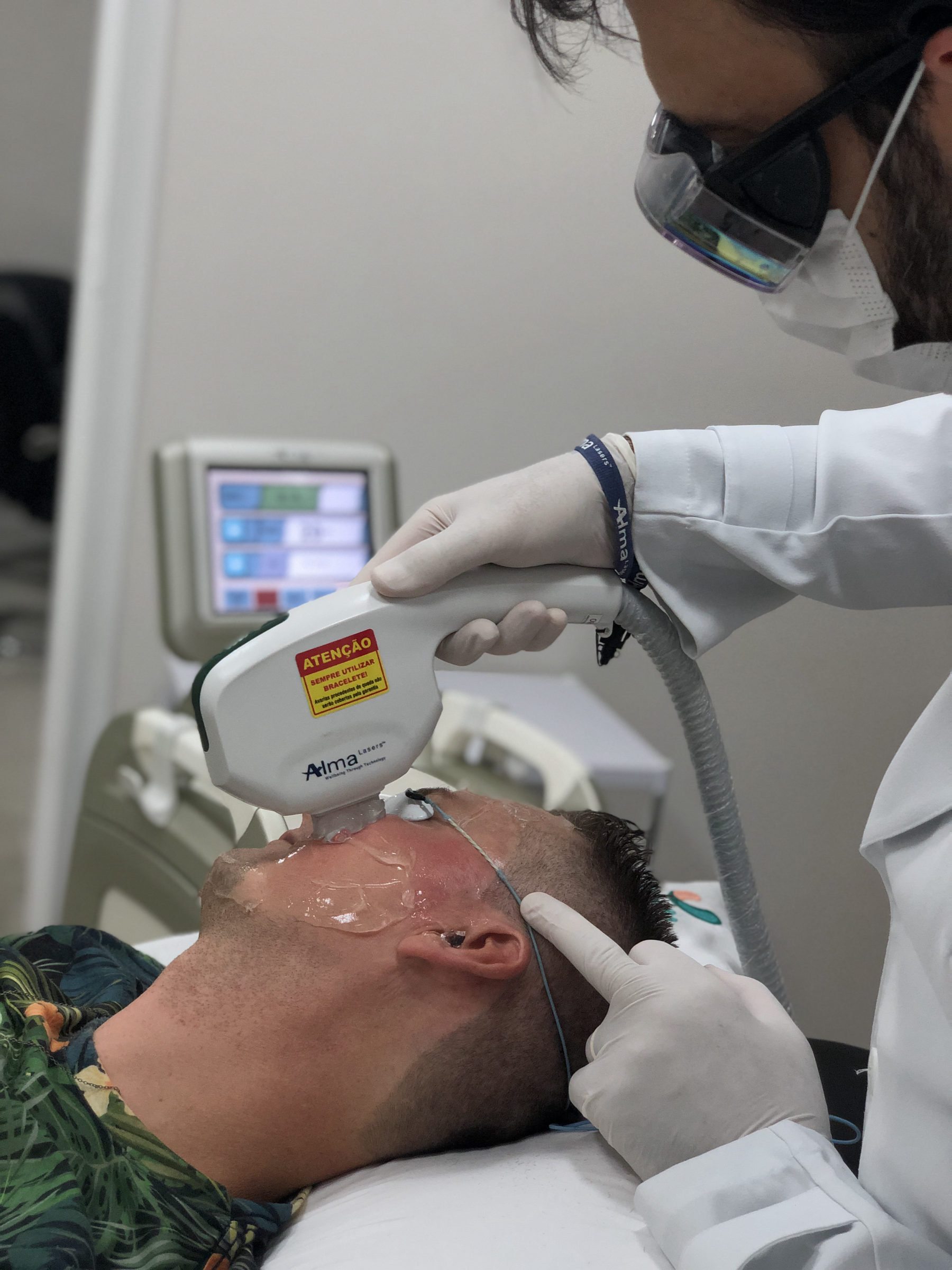 Tratamento de rosácea com Harmony Dye Laser na Inpelle
