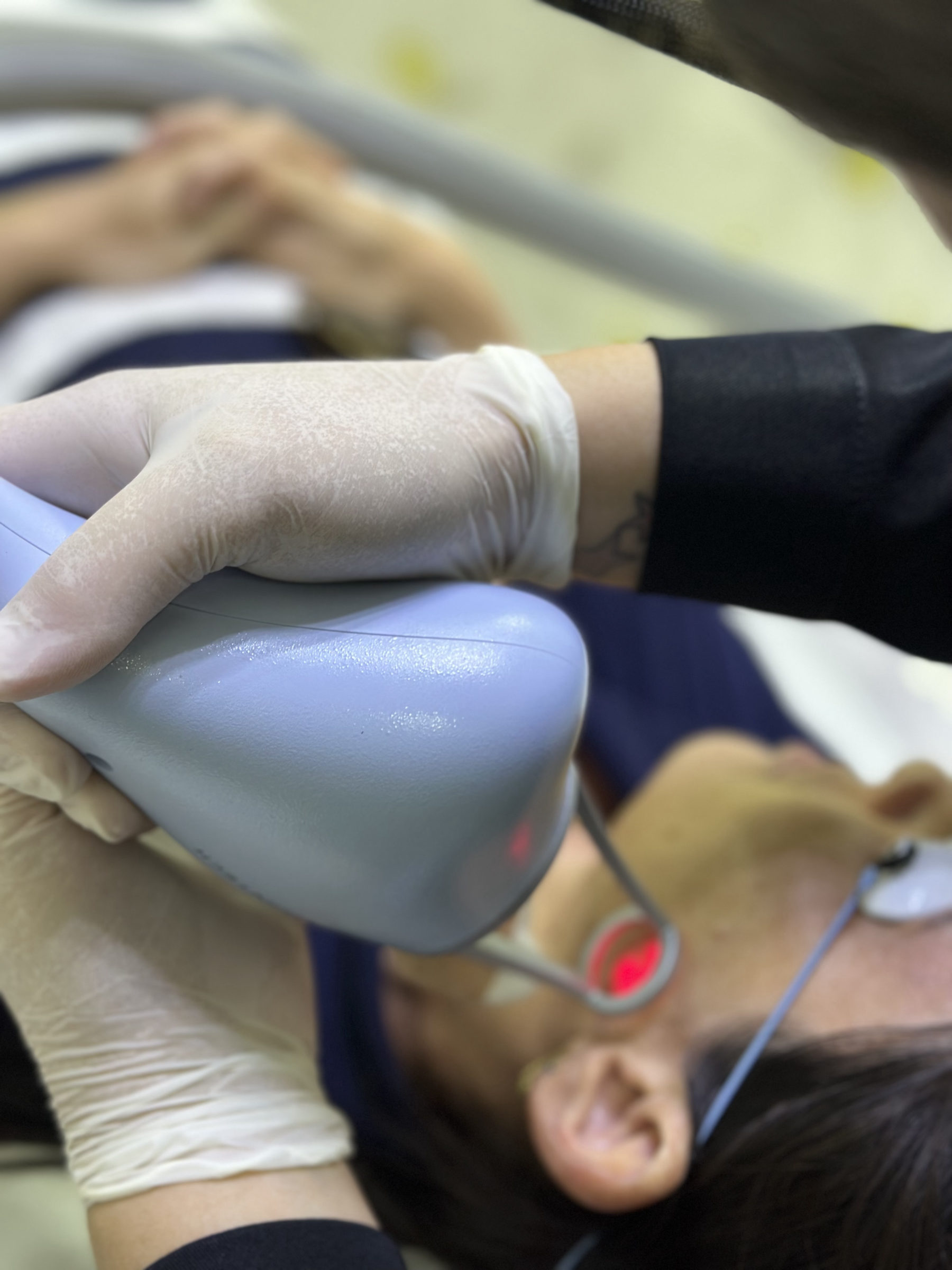 Aplicação do Laser Lavieen na Inpelle