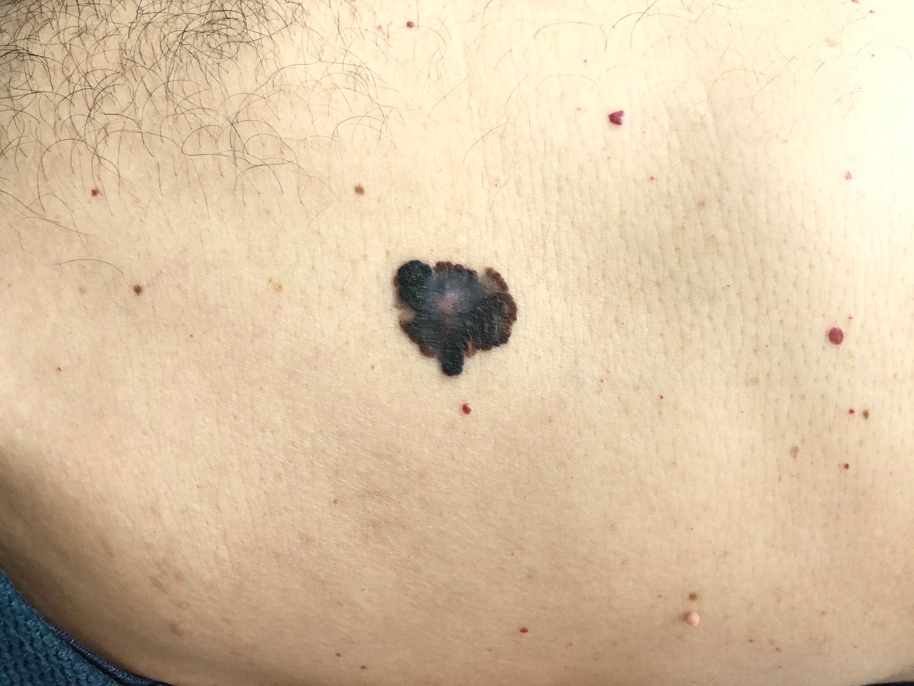 Lesão pigmentada assimétrica com bordas irregulares, exemplo de sinal de alerta para melanoma
