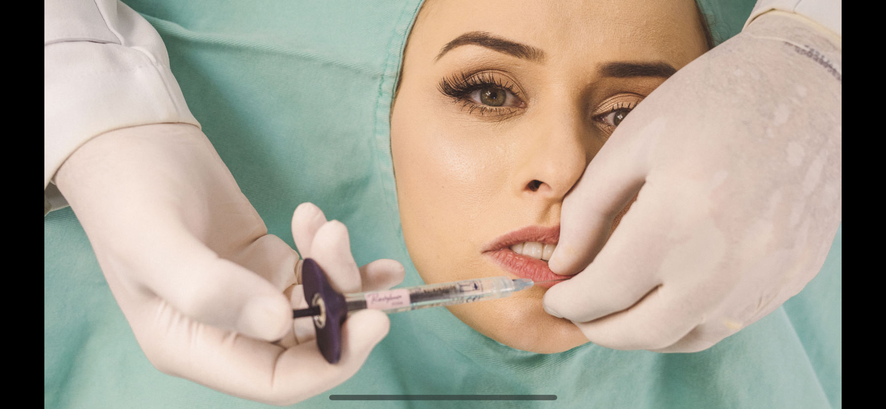 Aplicação de preenchimento labial na Inpelle