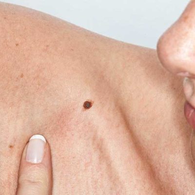 cancer-de-pele-clinica-inpelle-melanoma