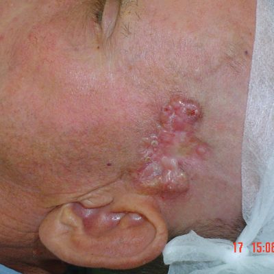 carcinoma-basocelular-exemplo