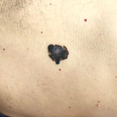 Lesão pigmentada assimétrica com bordas irregulares, exemplo de sinal de alerta para melanoma