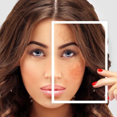 mulher-rosto-melasma-clinica-inpelle