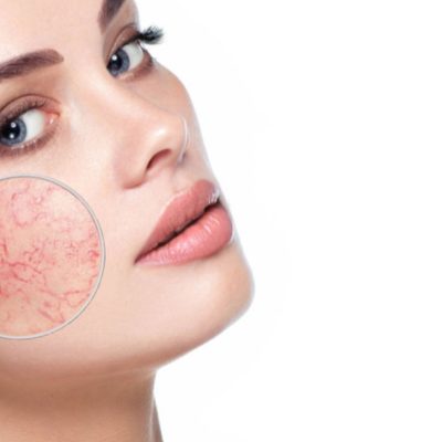 rosacea-inpelle-capa